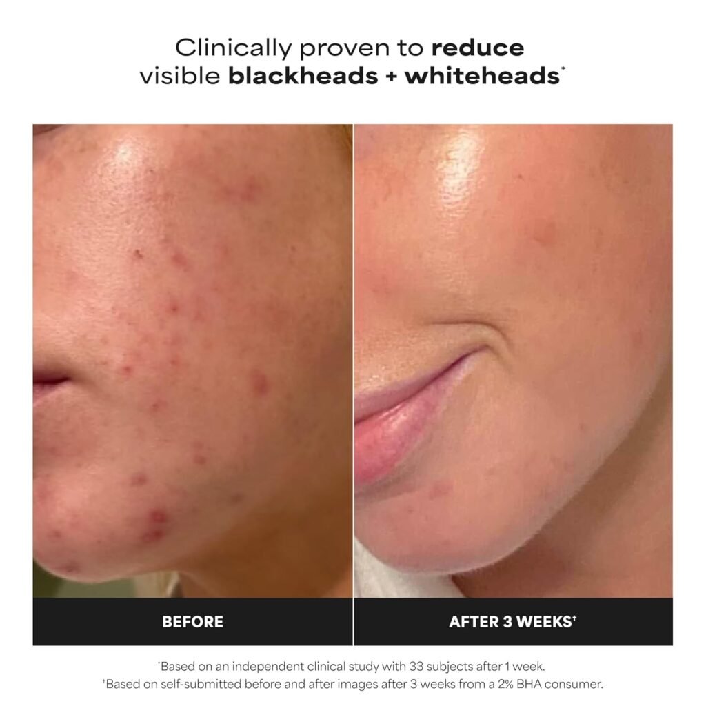 Before and After Use of Paula’s Choice 2% BHA Liquid Exfoliant