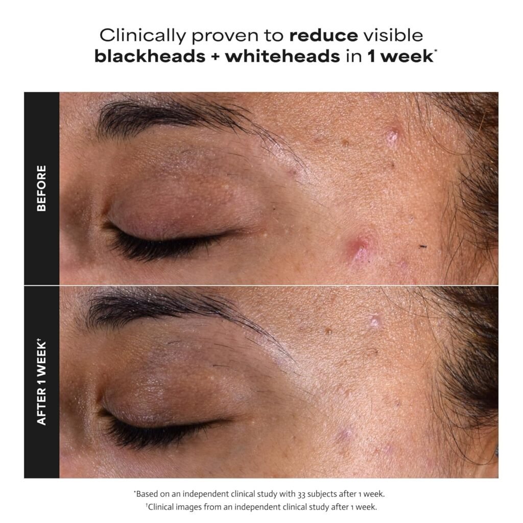 Before and After Use of Paula’s Choice 2% BHA Liquid Exfoliant