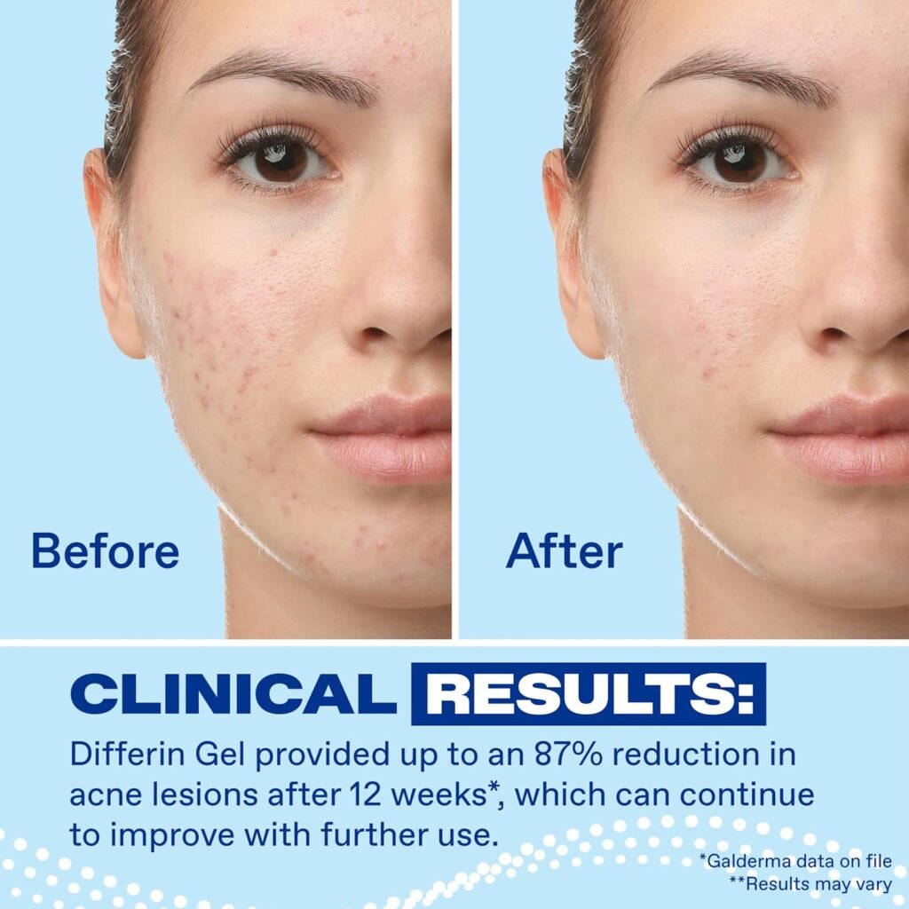 Is Differin Good for Sensitive, Acne-Prone Skin